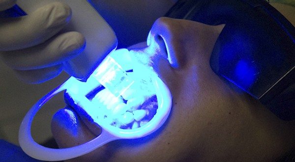 Los dentistas preocupados por el aumento de casos de blancorexia